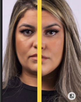 4 Aplicativos que Simula Botox no Rosto